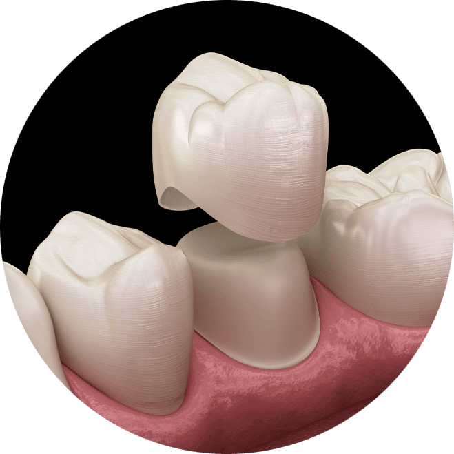 dental crown model