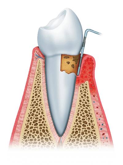 gum disease graphic stage 2