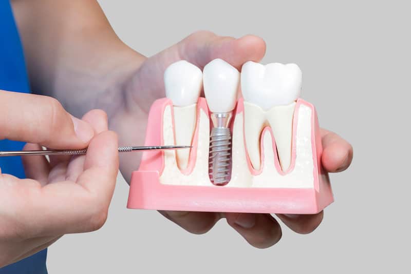 Dental Assistant Showing Off A Dental Implant In A Jawbone Cutaway Model in Woodbury, MN